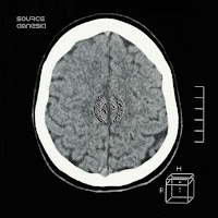 Aphasia - Source Amnesia загрузить